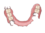 部分入れ歯