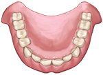 総入れ歯
