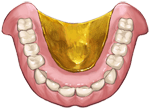 金・プラチナ製義歯