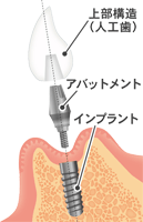 インプラント