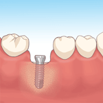 インプラント