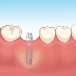 インプラント