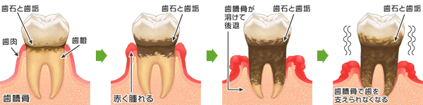 歯周病の進行イラスト