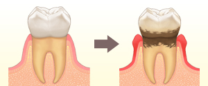 歯周病治療イメージ